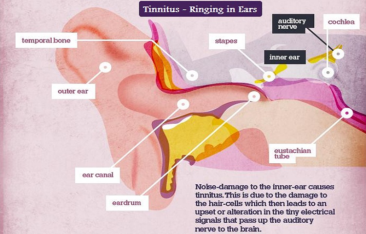 Natural home remedies for tinnitus- ringing in the ears